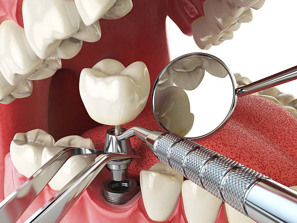 Best Emergency Root Canal Treatment in Wayland, MI